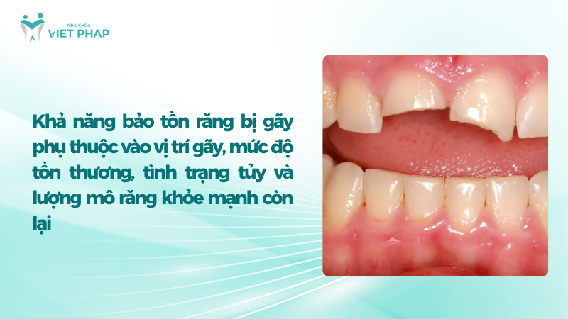 lam gi khi rang bi gay 2 Khả năng bảo tồn răng bị gãy phụ thuộc vào vị trí gãy, mức độ tổn thương, tình trạng tủy và lượng mô răng khỏe mạnh còn lại