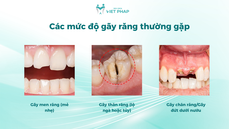 lam gi khi rang bi gay 3 Các mức độ gãy răng thường gặp