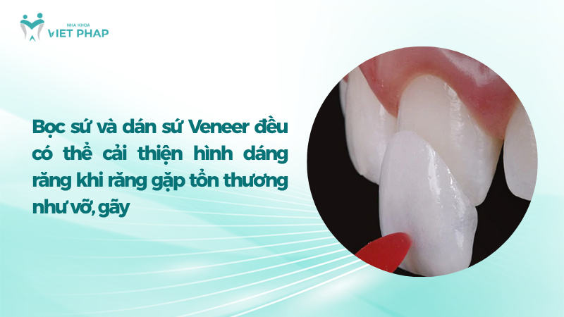 lam gi khi rang bi gay 4 Bọc sứ và dán sứ Veneer đều có thể cải thiện hình dáng răng khi răng gặp tổn thương như vỡ, gãy