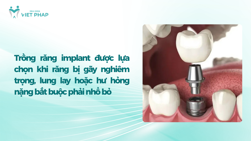 lam gi khi rang bi gay 5 Trồng răng implant được lựa chọn khi răng bị gãy nghiêm trọng, lung lay hoặc hư hỏng nặng bắt buộc phải nhổ bỏ