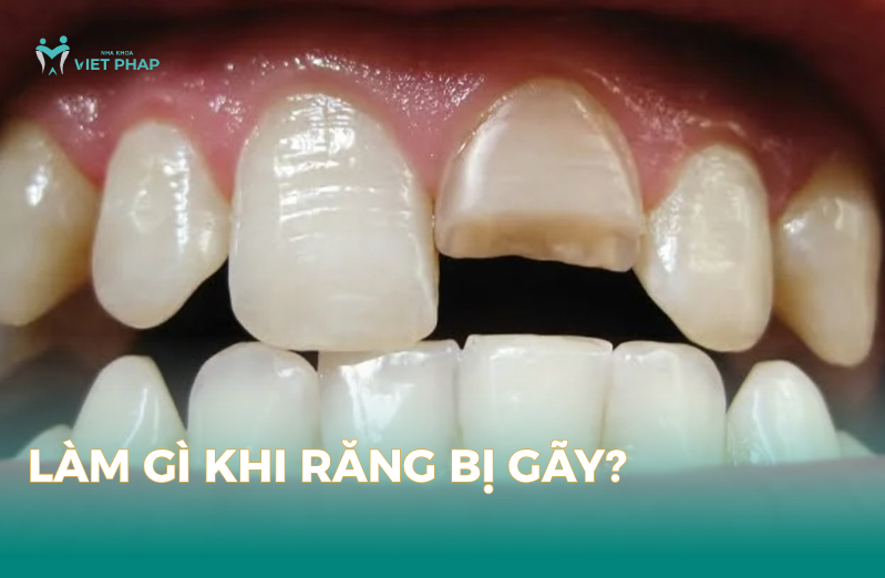 Làm gì khi răng bị gãy?