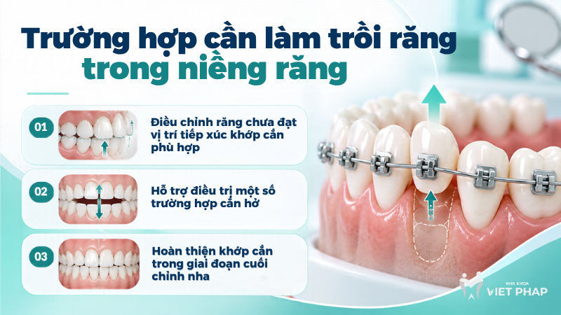 lam troi rang 2 Trường hợp cần làm trồi răng trong niềng răng