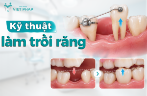 Kỹ thuật làm trồi răng và xử lý trồi răng đối diện do mất răng