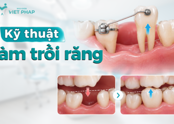 Kỹ thuật làm trồi răng và xử lý trồi răng đối diện do mất răng