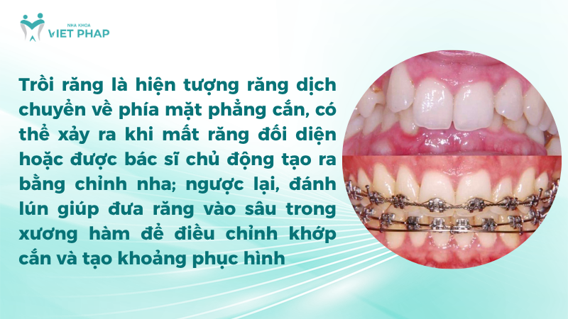 lam troi rang Trồi răng là hiện tượng răng dịch chuyển về phía mặt phẳng cắn, có thể xảy ra khi mất răng đối diện hoặc được bác sĩ chủ động tạo ra bằng chỉnh nha; ngược lại, đánh lún giúp đưa răng vào sâu trong xương hàm để điều chỉnh khớp cắn và tạo khoảng phục hình