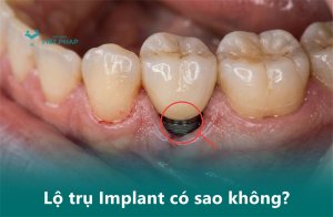 Lộ trụ Implant có sao không