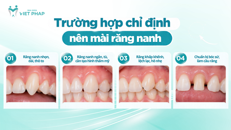 Các trường hợp có thể được chỉ định mài răng nanh