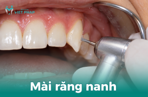 Mài răng nanh bằng dụng cụ nha khoa chuyên dụng.
