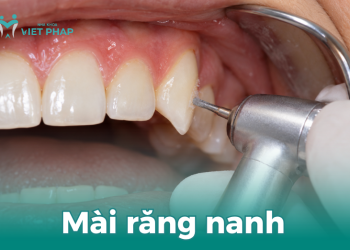 Mài răng nanh bằng dụng cụ nha khoa chuyên dụng.