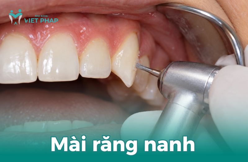 Mài răng nanh bằng dụng cụ nha khoa chuyên dụng.