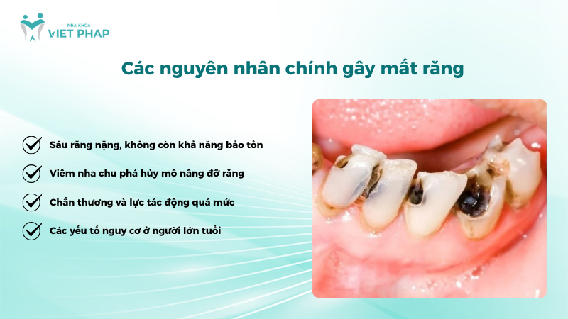 Các nguyên nhân chính gây mất răng