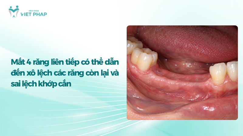 Mất 4 răng liên tiếp có thể dẫn đến xô lệch các răng còn lại và sai lệch khớp cắn