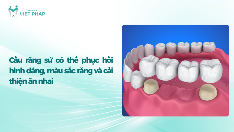 Cầu răng sứ có thể phục hồi hình dáng, màu sắc răng và cải thiện ăn nhai