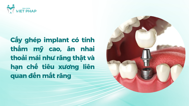 Cấy ghép implant có tính thẩm mỹ cao, ăn nhai thoải mái như răng thật và hạn chế tiêu xương liên quan đến mất răng