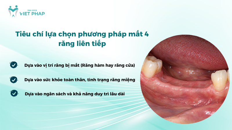 Tiêu chí lựa chọn phương pháp mất 4 răng liên tiếp