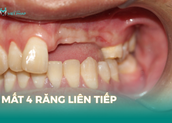 mất 4 răng liên tiếp