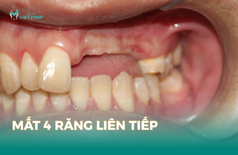 mất 4 răng liên tiếp