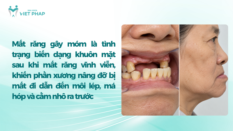 Hình ảnh mất nhiều răng và khuôn mặt môi lép, má hóp, cằm nhô