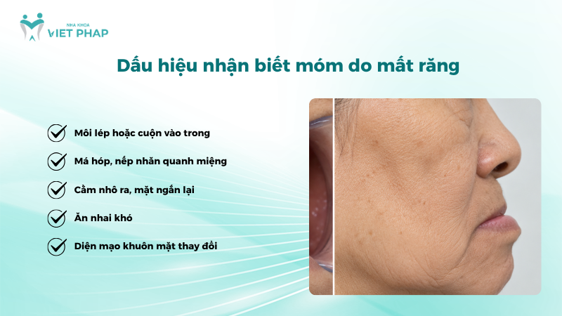 Các dấu hiệu móm do mất răng gồm môi lép, má hóp, cằm nhô và ăn nhai khó
