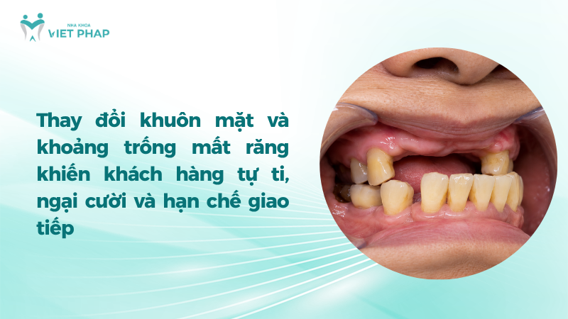 Khoảng trống mất nhiều răng ảnh hưởng đến nụ cười