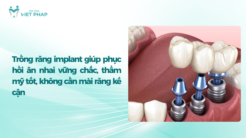Mô hình phục hình răng bằng trụ Implant và cầu răng phía trên