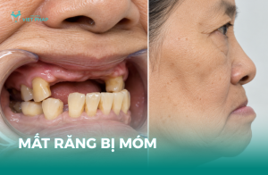 Mất răng bị móm với hình ảnh mất nhiều răng và góc nghiêng khuôn mặt