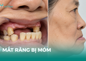 Mất răng bị móm với hình ảnh mất nhiều răng và góc nghiêng khuôn mặt