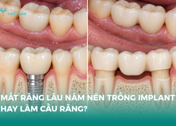 So sánh phục hình răng mất bằng Implant và cầu răng sứ