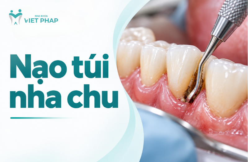 Nạo túi nha chu là gì? Trường hợp nên và không nên, lợi ích, quy trình và chi phí cần biết