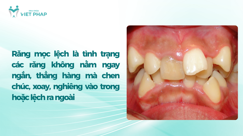 Răng mọc lệch là tình trạng các răng không nằm ngay ngắn, thẳng hàng mà chen chúc, xoay, nghiêng vào trong hoặc lệch ra ngoài