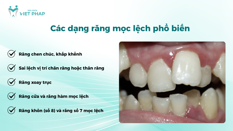 Các dạng răng mọc lệch phổ biến