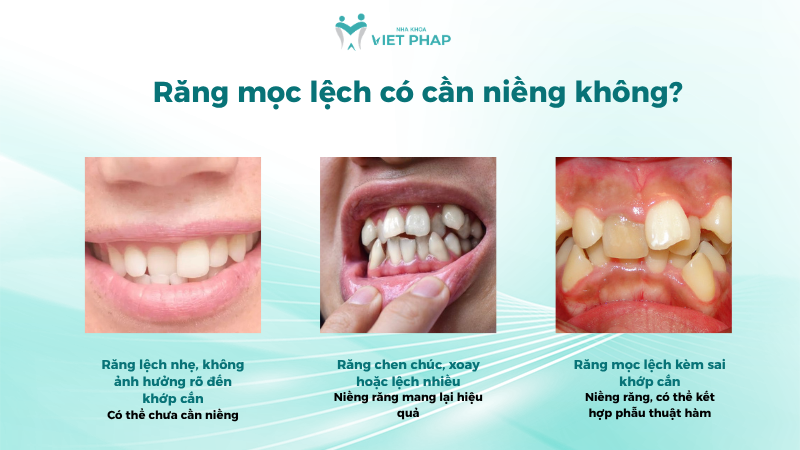 Răng mọc lệch có cần niềng không?
