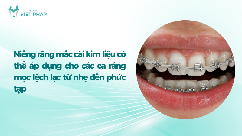 Niềng răng mắc cài kim liệu có thể áp dụng cho các ca răng mọc lệch lạc từ nhẹ đến phức tạp