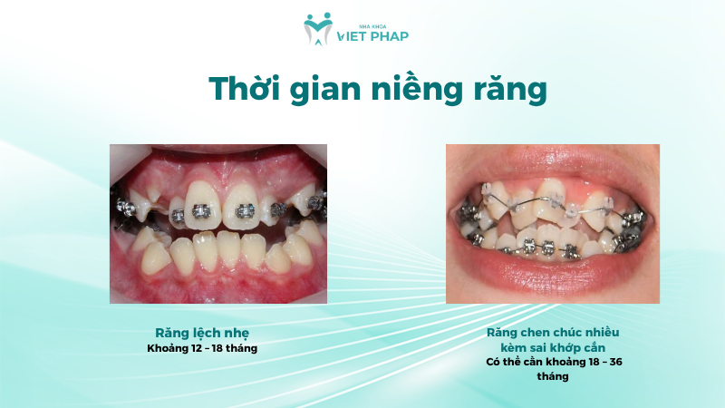 Thời gian niềng răng 