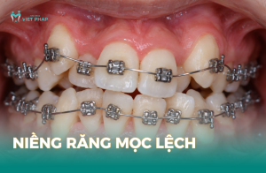 Niềng răng mọc lệch
