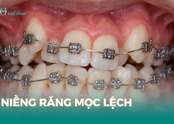 Niềng răng mọc lệch