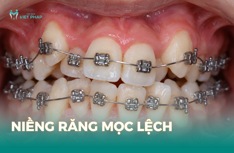 Niềng răng mọc lệch