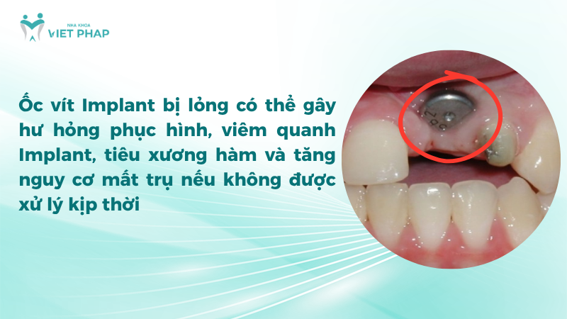 Ốc vít Implant bị lỏng có thể gây hư hỏng phục hình, viêm quanh Implant và tiêu xương hàm