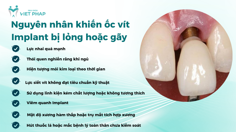 Nguyên nhân khiến ốc vít Implant bị lỏng hoặc gãy
