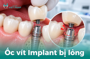 Ốc vít Implant bị lỏng