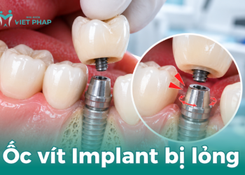 Ốc vít Implant bị lỏng