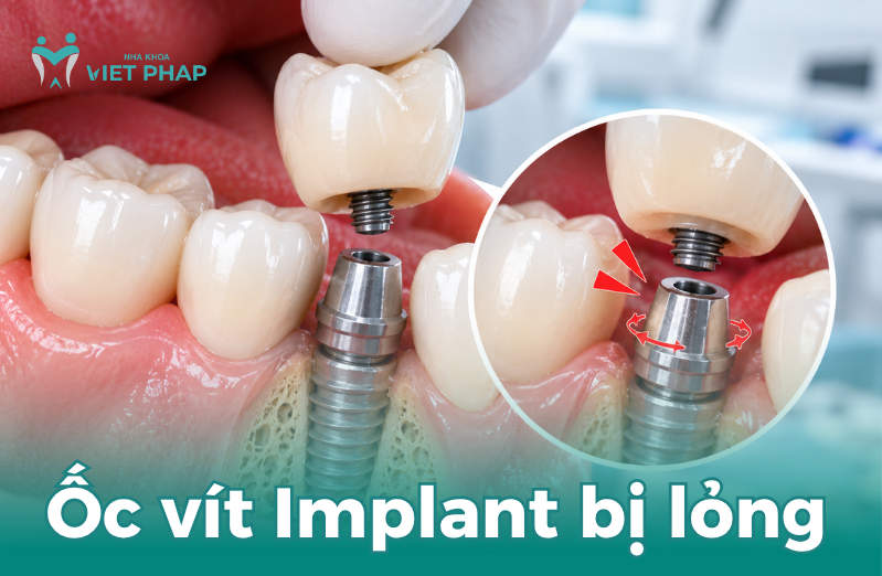 Ốc vít Implant bị lỏng
