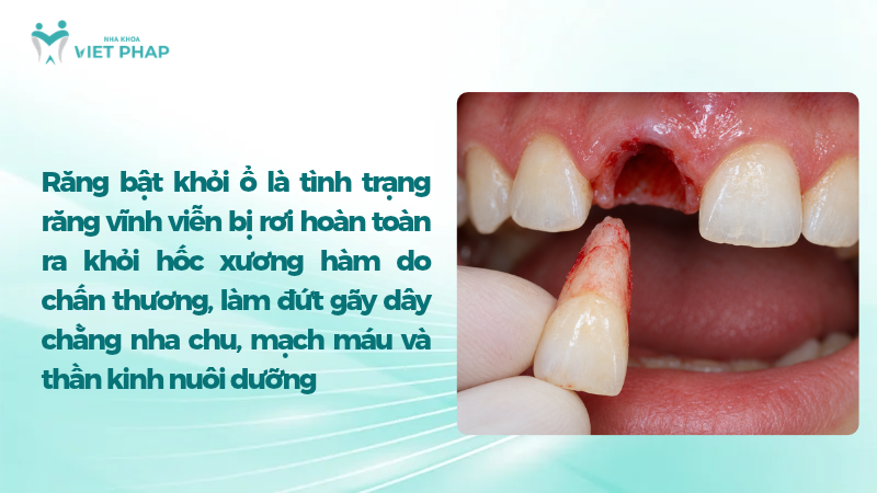 Răng cửa bật hoàn toàn khỏi ổ răng sau chấn thương