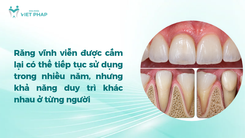 Minh họa răng và mô quanh răng sau khi cắm lại răng vĩnh viễn
