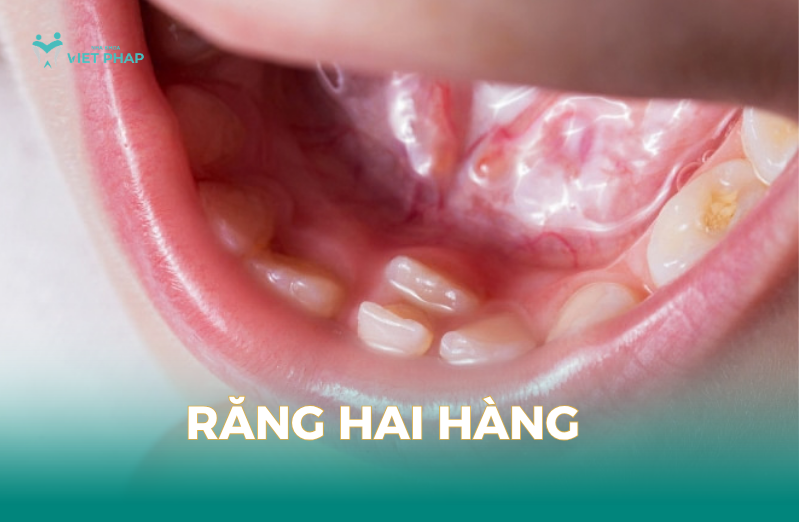 Răng hai hàng