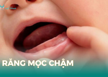 Răng mọc chậm