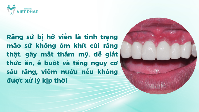 Răng sứ bị hở viền là tình trạng mão sứ không ôm khít cùi răng thật, gây mất thẩm mỹ, dễ giắt thức ăn, ê buốt và tăng nguy cơ sâu răng, viêm nướu nếu không được xử lý kịp thời