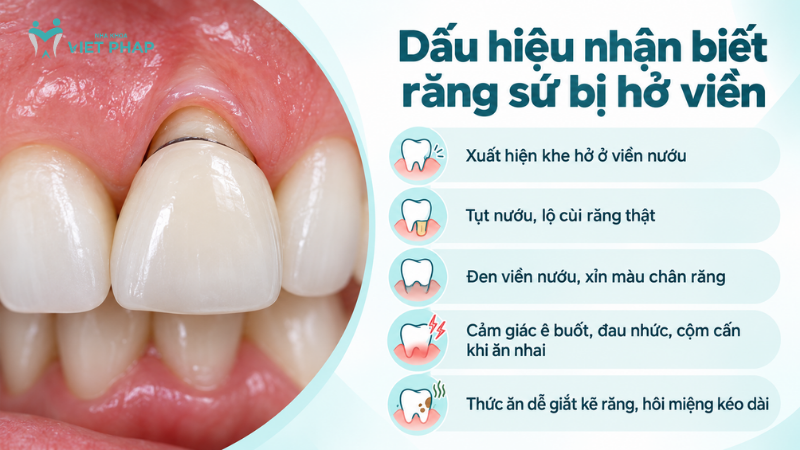 Dấu hiệu nhận biết răng sứ bị hở viền
