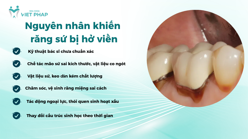 Nguyên nhân khiến răng sứ bị hở viền