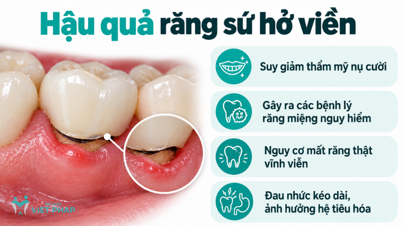 Hậu quả răng sứ hở viền